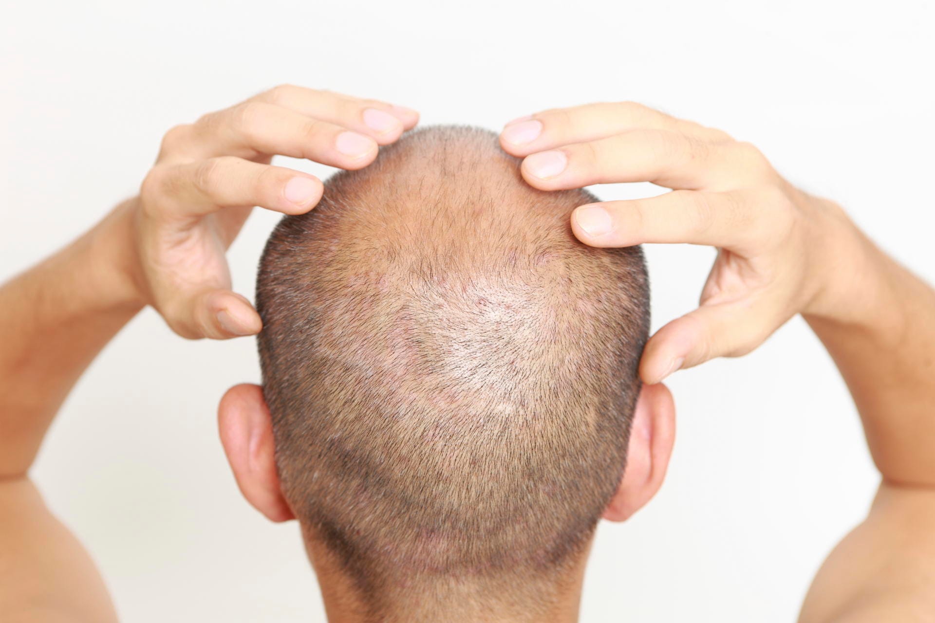 80 Prozent aller Männer leiden unter Haarausfall. Viele plagen sich mit Haarwuchsmitteln, Haarfüllern und Co.