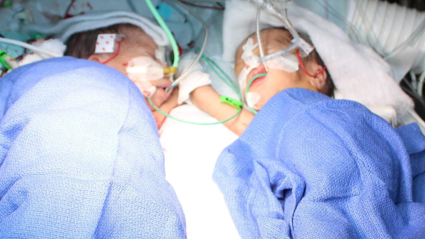 Die beiden Zwillinge Lydia und Maya nach ihrer Trennung im Berner Krankenhaus.