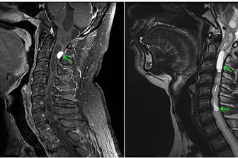 Kernspin-Bilder vom Kopf des Patienten: Der grüne Pfeil im linken Bild zeigt auf einen Knoten des Tumors, die grünen Pfeile im rechten Bild auf die Hohlräume.