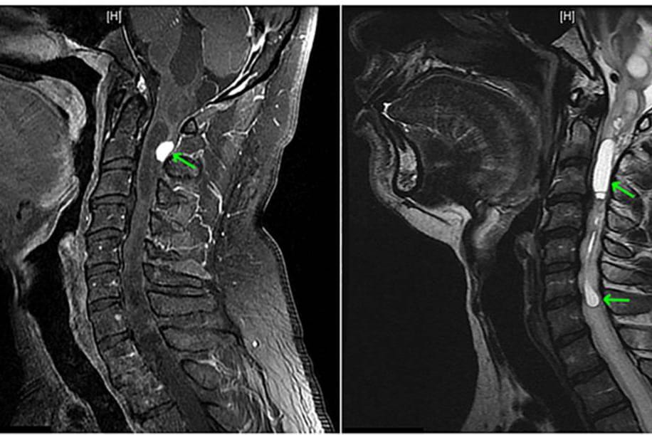 Kernspin-Bilder vom Kopf des Patienten: Der grüne Pfeil im linken Bild zeigt auf einen Knoten des Tumors, die grünen Pfeile im rechten Bild auf die Hohlräume.