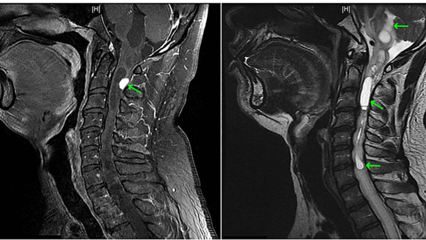 Kernspin-Bilder vom Kopf des Patienten: Der grüne Pfeil im linken Bild zeigt auf einen Knoten des Tumors, die grünen Pfeile im rechten Bild auf die Hohlräume.