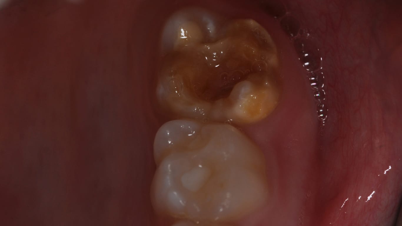Verfärbte und geschädigte Zähne sind ein typisches Erscheinungsbild bei Molaren-Inzisiven-Hypomineralisation