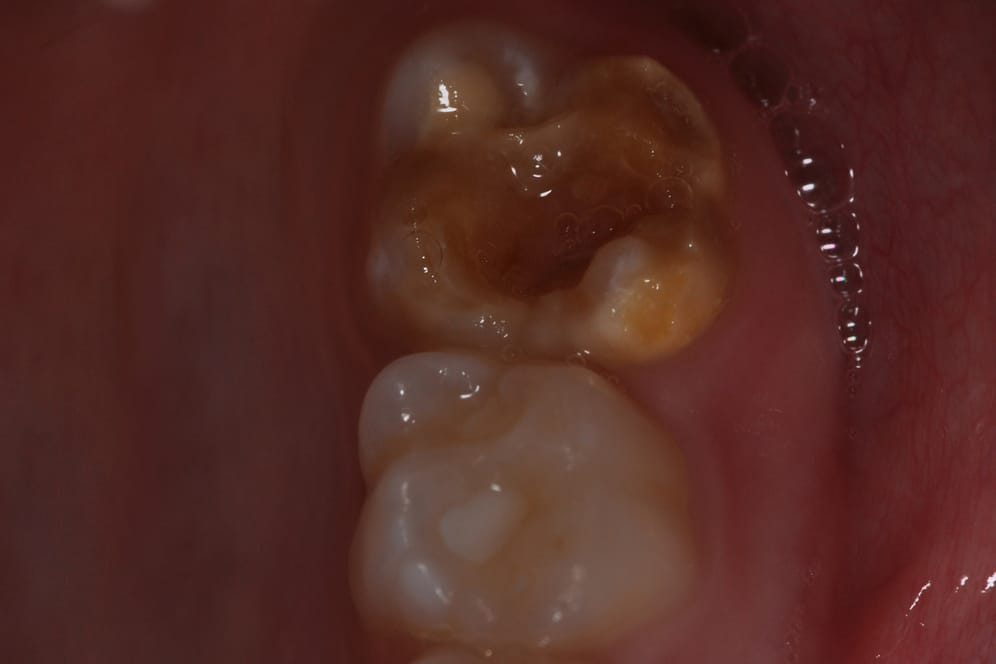 Verfärbte und geschädigte Zähne sind ein typisches Erscheinungsbild bei Molaren-Inzisiven-Hypomineralisation