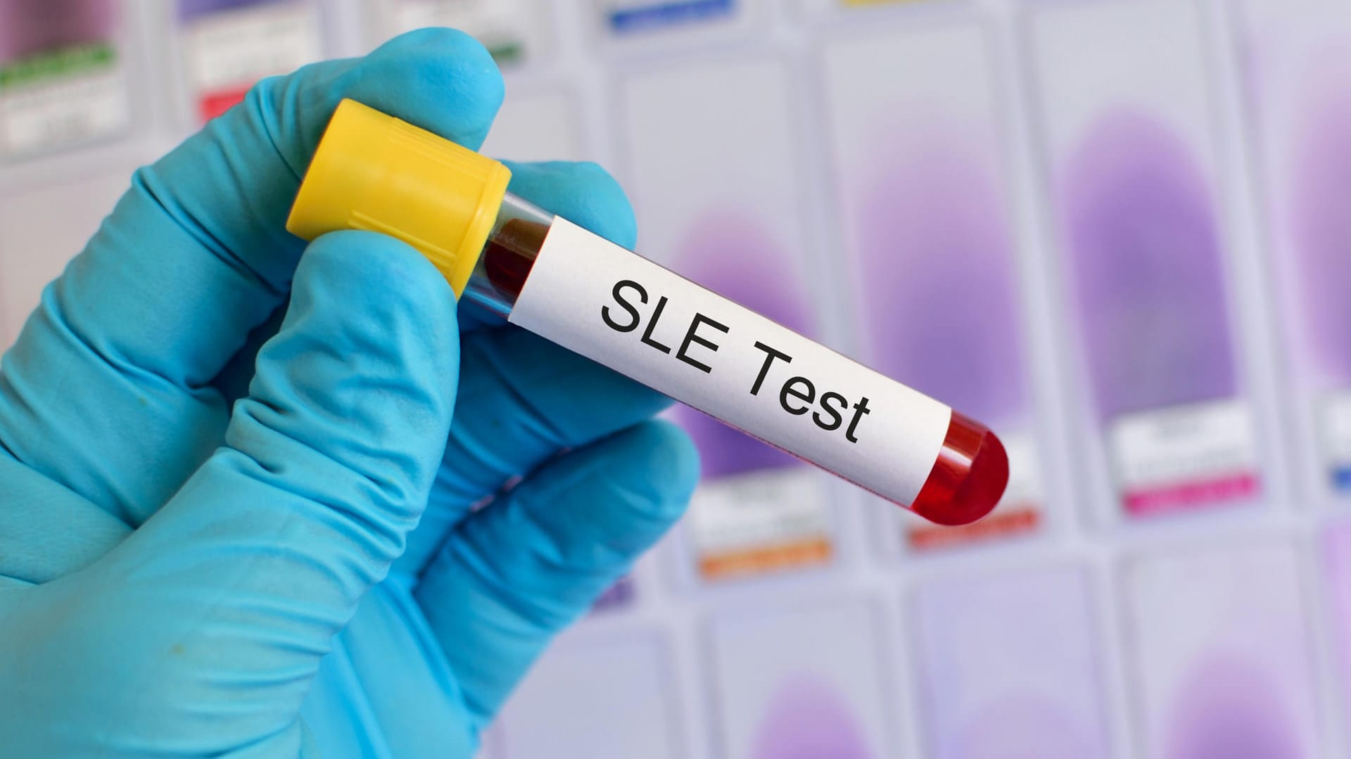 Systemischer Lupus Erythematodes (SLE) kann mit einem Bluttest festgestellt werden.