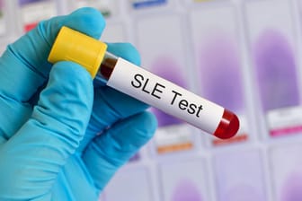 Systemischer Lupus Erythematodes (SLE) kann mit einem Bluttest festgestellt werden.