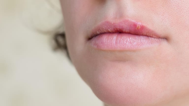 Zinksalbe gegen lippenherpes - Betrachten Sie dem Testsieger