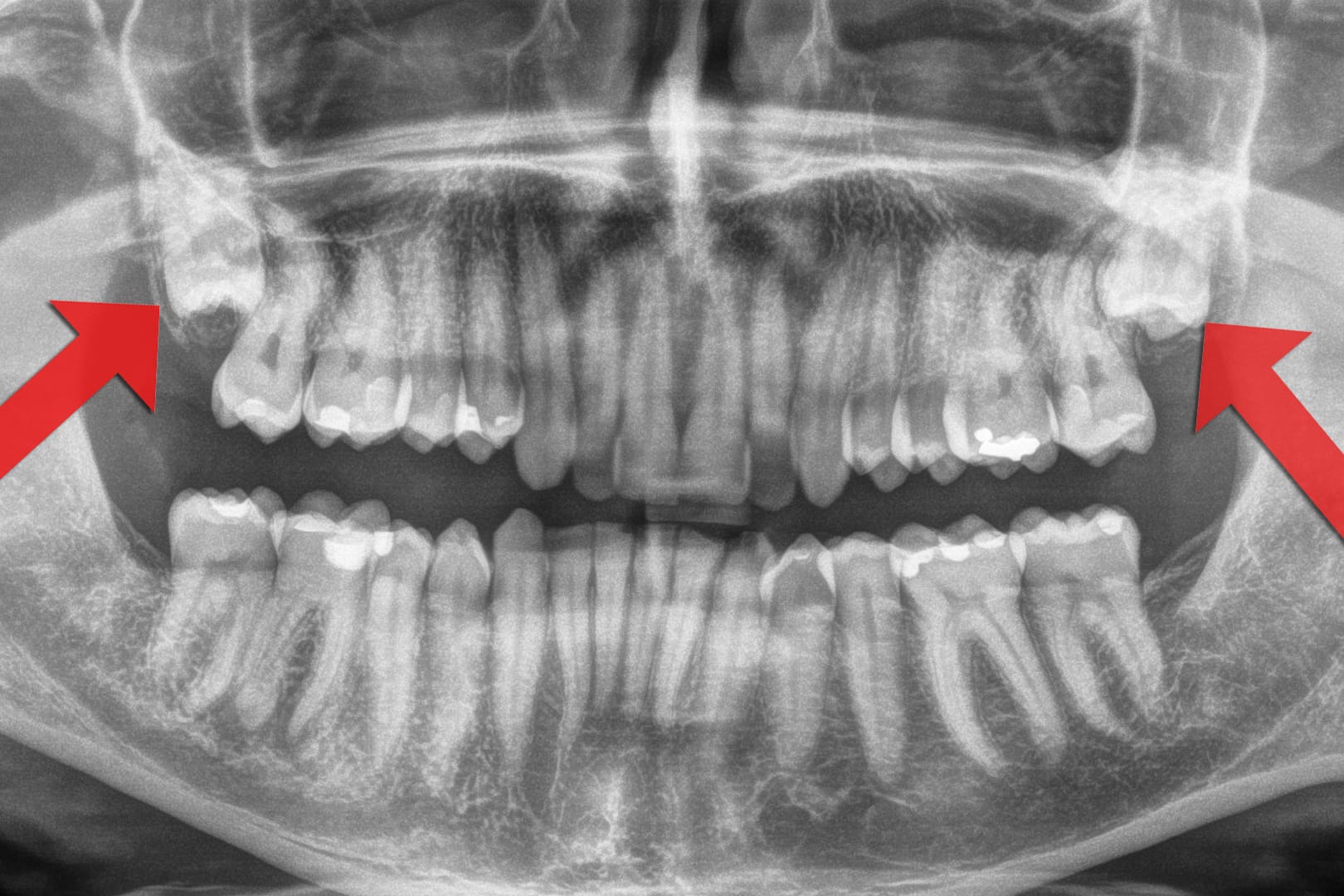 Auf dem Röntgenbild gut zu sehen: Im Oberkiefer stecken noch zwei Weisheitszähne, die bisher nicht durchgebrochen sind.