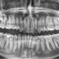 Auf dem Röntgenbild gut zu sehen: Im Oberkiefer stecken noch zwei Weisheitszähne, die bisher nicht durchgebrochen sind.