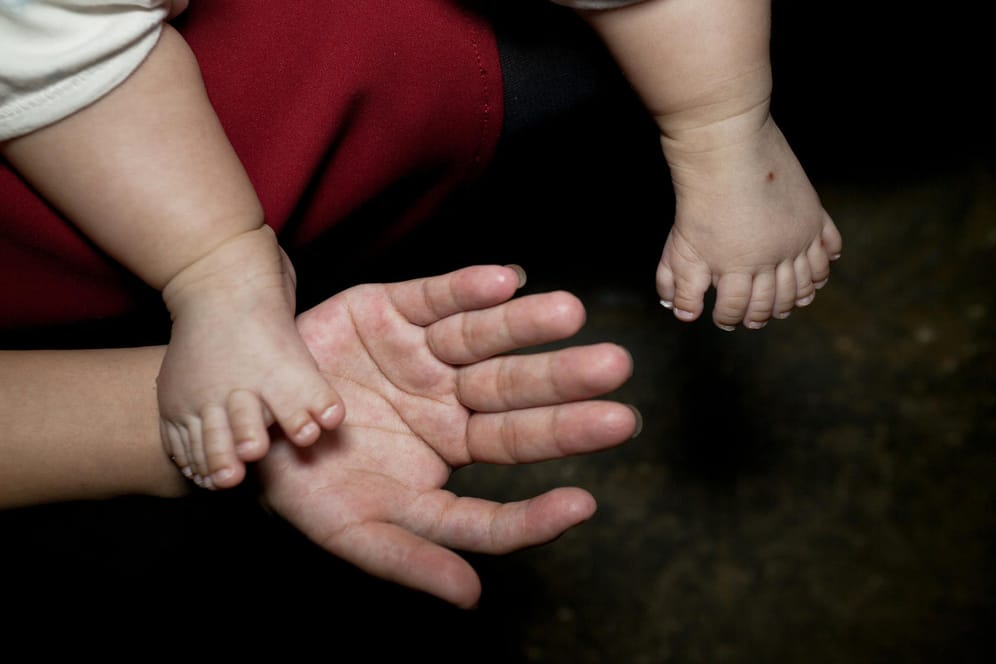 Zusätzliche Finger oder Zehen treten ungefähr bei jedem 500. Kind auf.