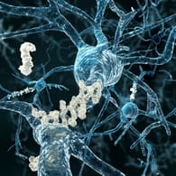 Grafische Darstellung von Nervenzellen, an denen Amyloid-Plaques haften. Diese Plaques verursachen Alzheimer.