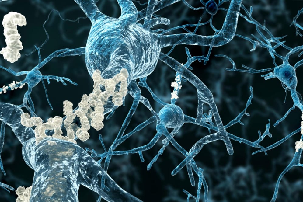 Grafische Darstellung von Nervenzellen, an denen Amyloid-Plaques haften. Diese Plaques verursachen Alzheimer.