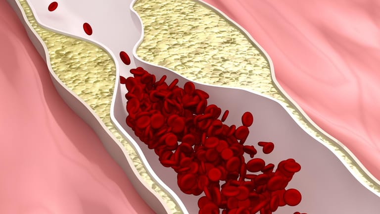 Ablagerungen im Blutgefäß