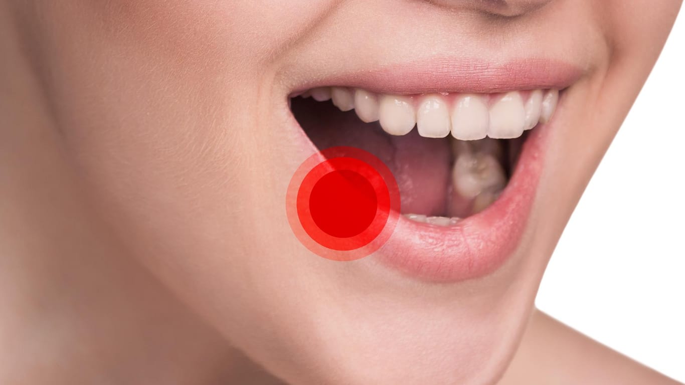 Mundfäule wird durch Herpes ausgelöst und ist stark ansteckend, es ist also Vorsicht geboten.