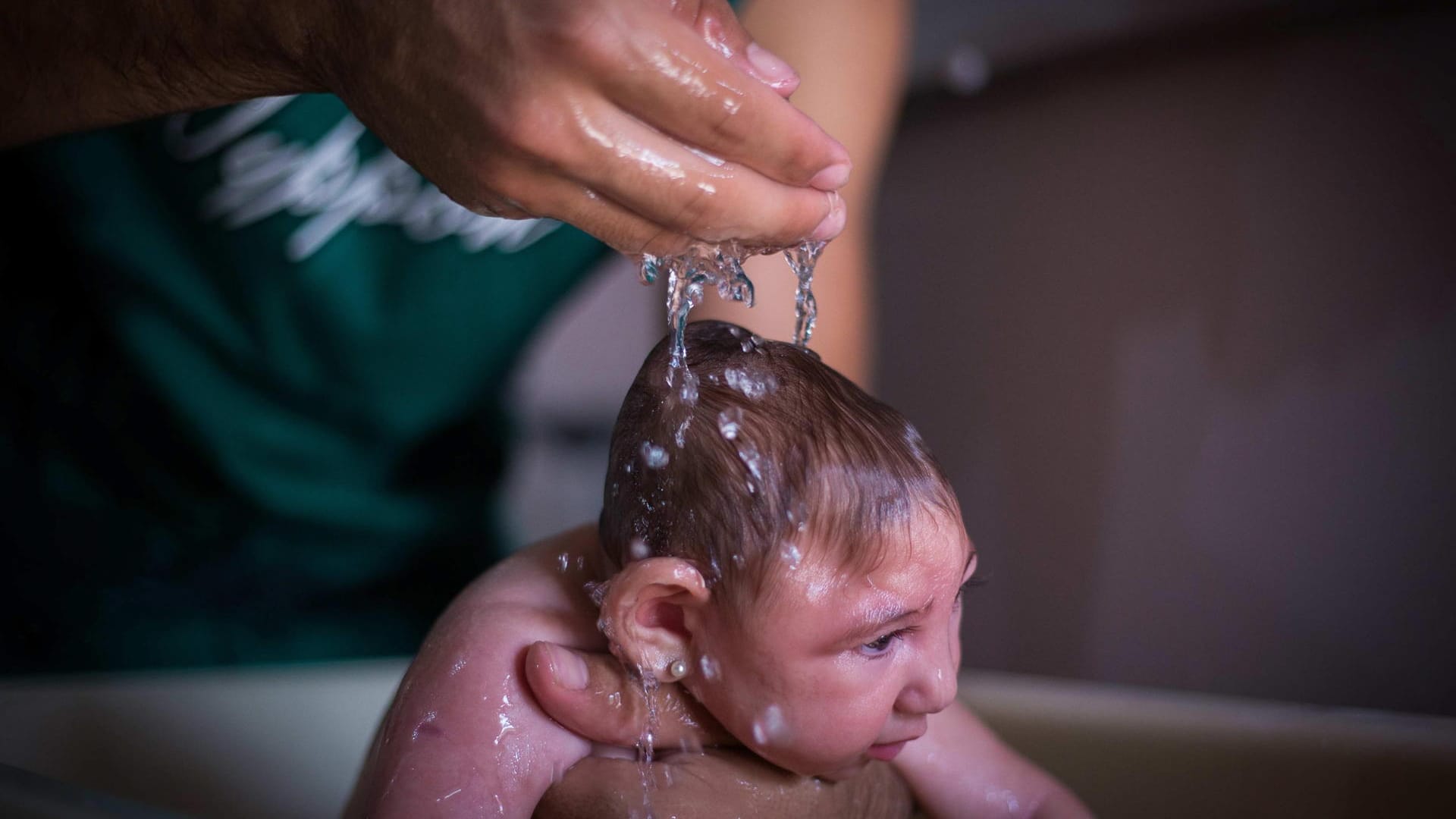 Baby mit Mikrozephalie. Das Zika-Virus kann zu der Fehlbildung führen.