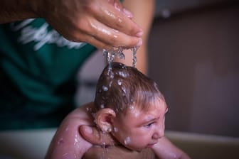 Baby mit Mikrozephalie. Das Zika-Virus kann zu der Fehlbildung führen.