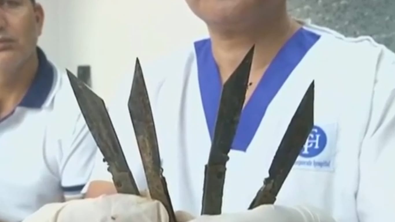Diese und weitere Messer holte ein Ärzteteam aus dem Bauch eines Mannes.