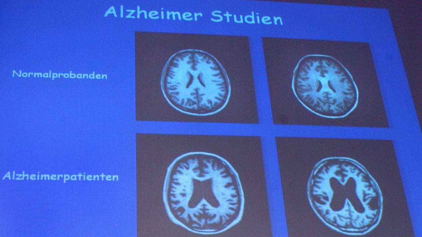 Alzheimer ist bislang nicht heilbar, aber es gibt eine neue vielversprechende Therapie.