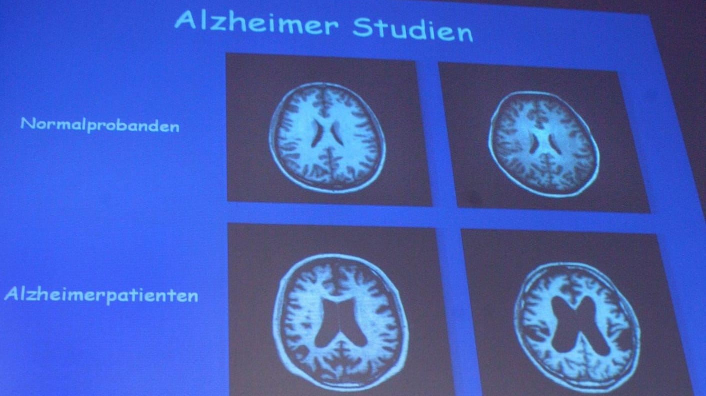 Alzheimer ist bislang nicht heilbar, aber es gibt eine neue vielversprechende Therapie.