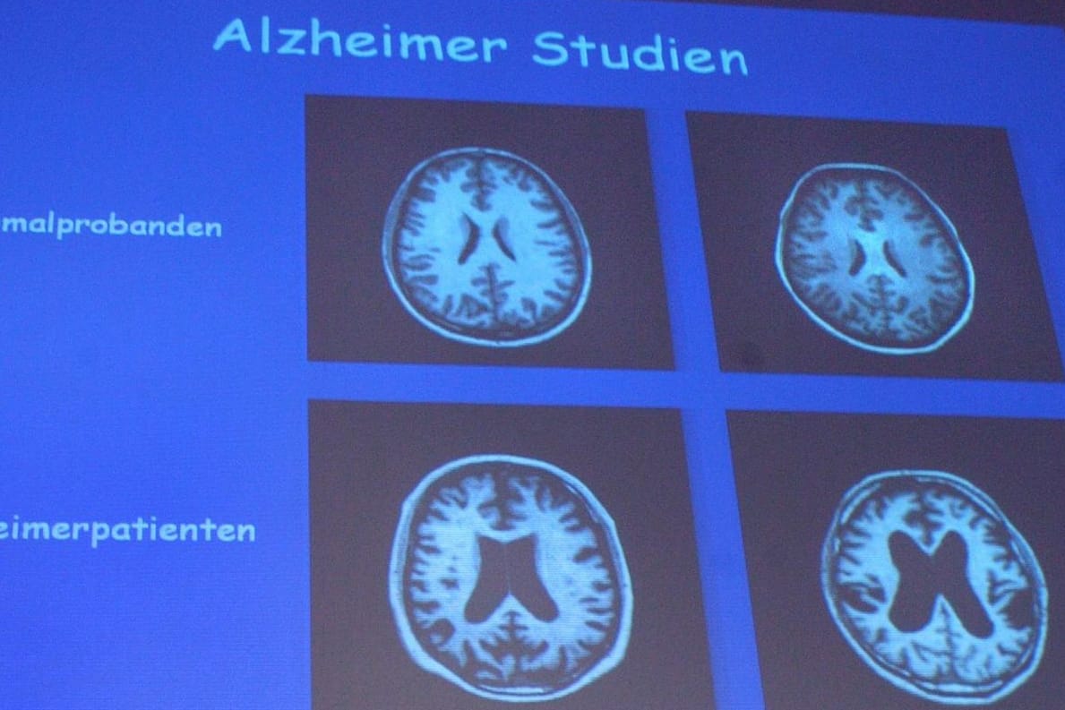 Alzheimer ist bislang nicht heilbar, aber es gibt eine neue vielversprechende Therapie.