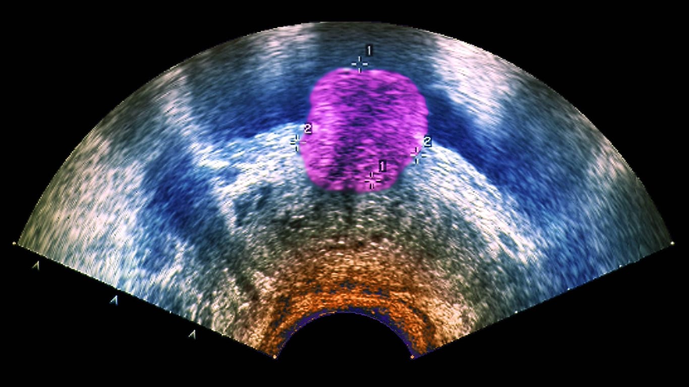 Ein Prostata-Tumor im Ultraschall. In manchen Fällen kommt eine neue Behandlungsmethode in Frage.
