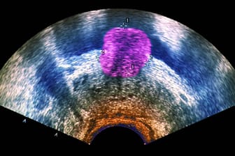 Ein Prostata-Tumor im Ultraschall. In manchen Fällen kommt eine neue Behandlungsmethode in Frage.