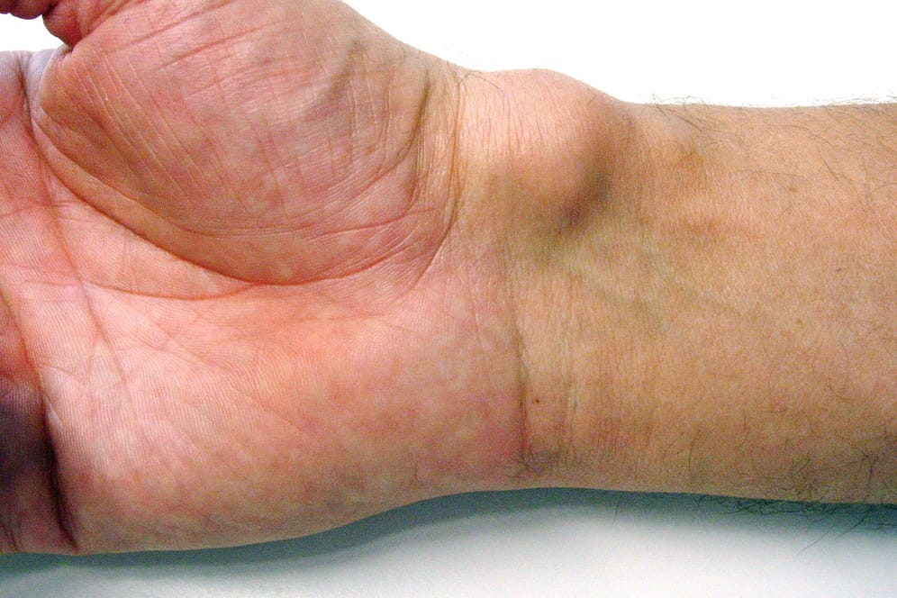Überbein: Die Schwellung am Handgelenk muss nur selten per Operation entfernt werden.