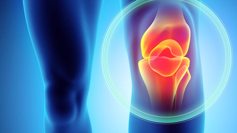 Das Knie gehört zu dem von Arthrose am meisten bestroffenen Korperteilen.