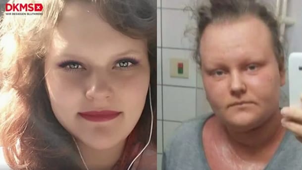 Der Kampf gegen den Krebs hat bei Lydia deutliche Spuren hinterlassen.