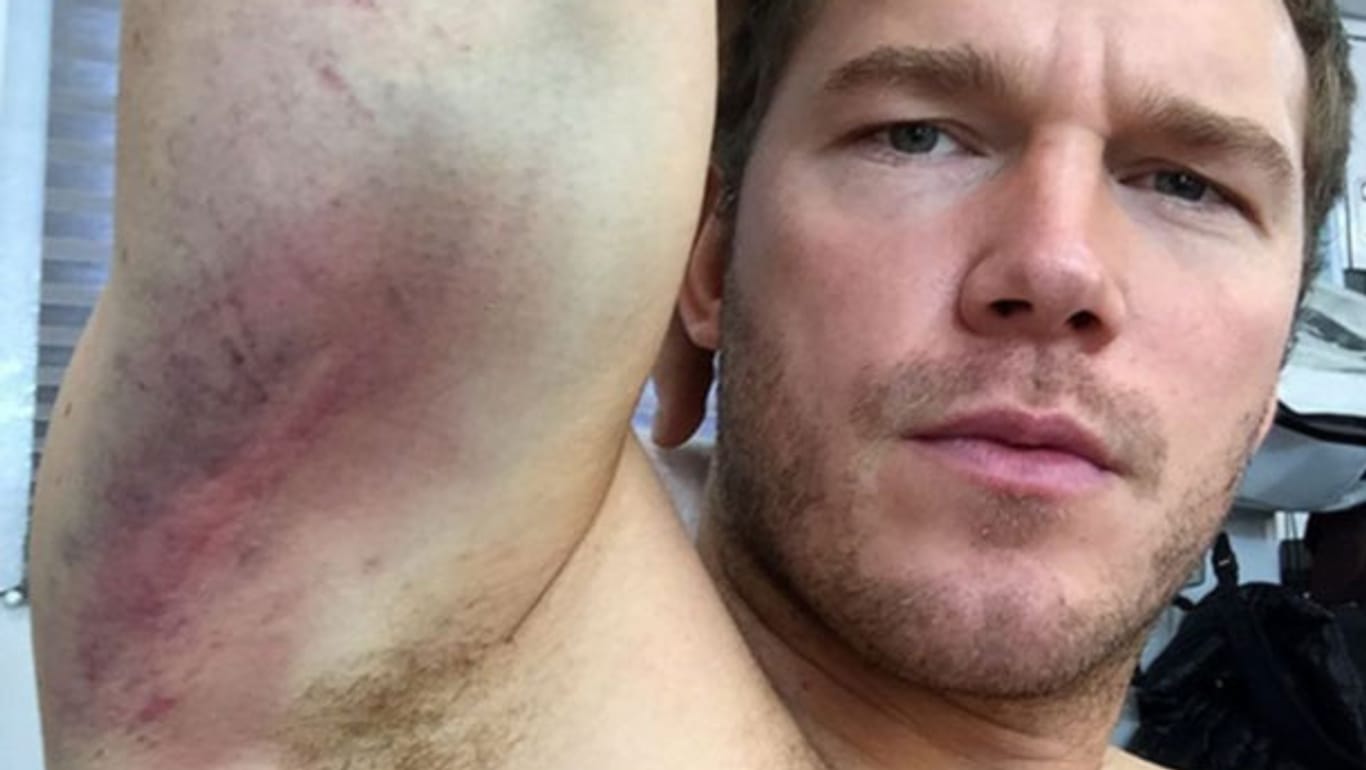 Hollywood-Star Chris Pratt hat sich bei einem Stunt Quetschungen und Schürfwunden zugezogen. Beide Arme sind lädiert.