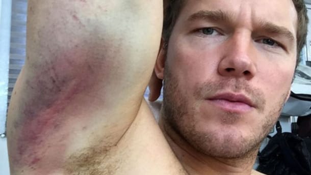 Hollywood-Star Chris Pratt hat sich bei einem Stunt Quetschungen und Schürfwunden zugezogen. Beide Arme sind lädiert.