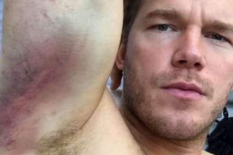 Hollywood-Star Chris Pratt hat sich bei einem Stunt Quetschungen und Schürfwunden zugezogen. Beide Arme sind lädiert.