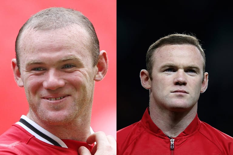 Fußballer Wayne Rooney wollte nicht länger mit schütterem Haar auf den Rasen. Er half mit einer Haartransplantation nach.
