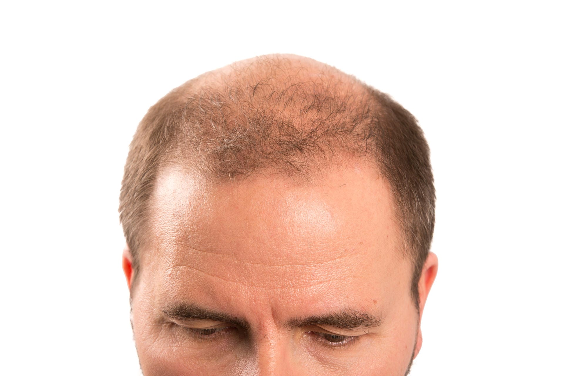 Auch wenn am Vorderkopf noch Haar vorhanden ist, genau dieses sollte für einen gediegenen Look raspelkurz geschnitten werden.
