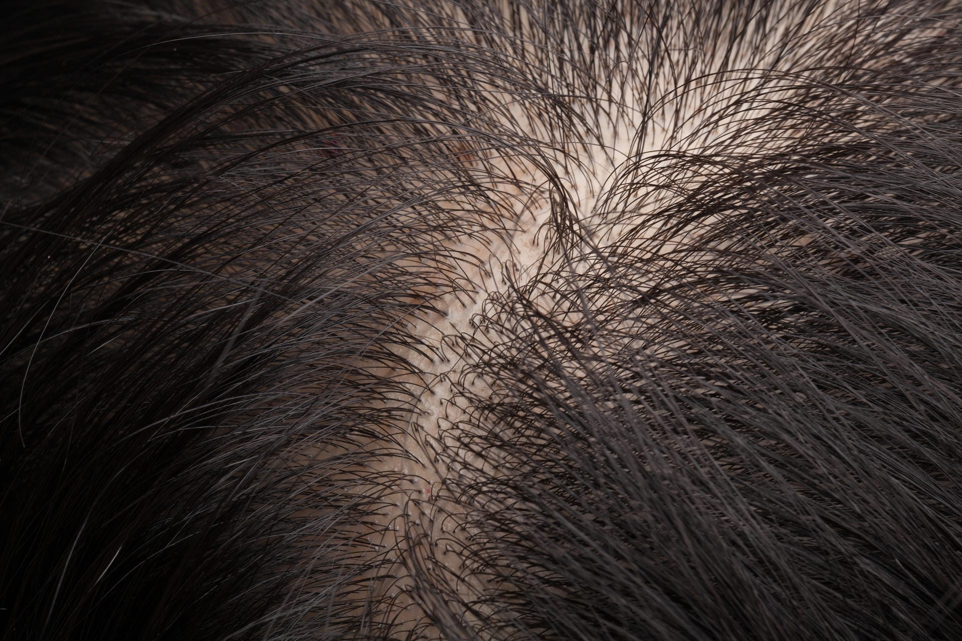 Bei dunklem Haar fallen kahle Stellen deutlich mehr auf, da die Kopfhaut viel heller durchscheint.