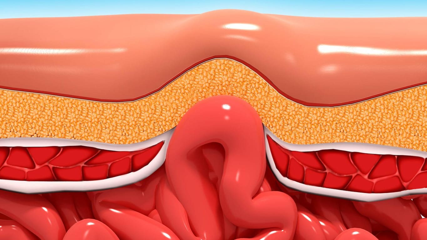 Leistenbruch: Durch den Riss kann sich ein Teil des Darms schieben. Sie spüren dann eine Beule an der Stelle und wissen, dass es eine Leistenhernie ist.