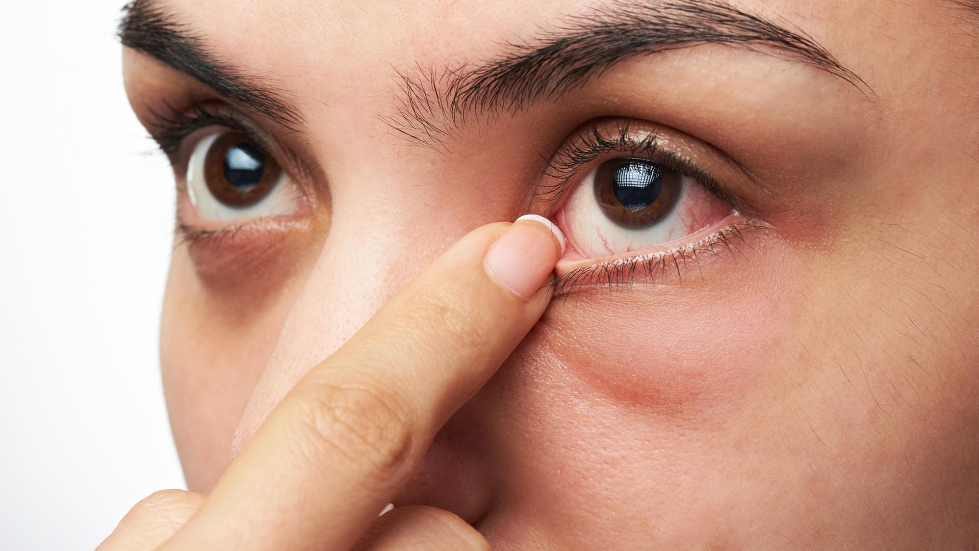 Tränensäcke: Gereizte Augen brennen unangenehm. Dennoch gilt: nicht reiben – das macht die Sache nur noch schlimmer.