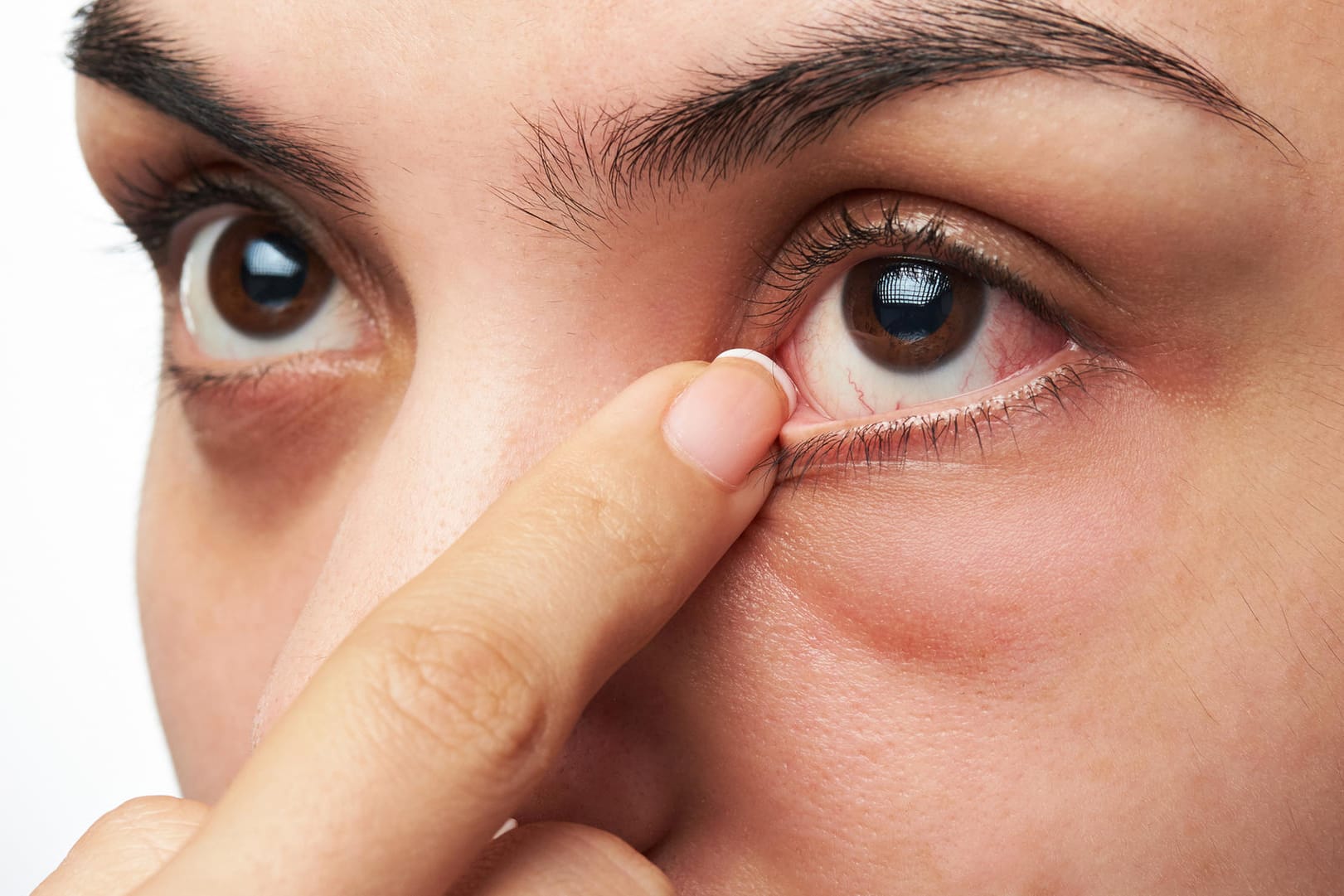 Tränensäcke: Gereizte Augen brennen unangenehm. Dennoch gilt: nicht reiben – das macht die Sache nur noch schlimmer.