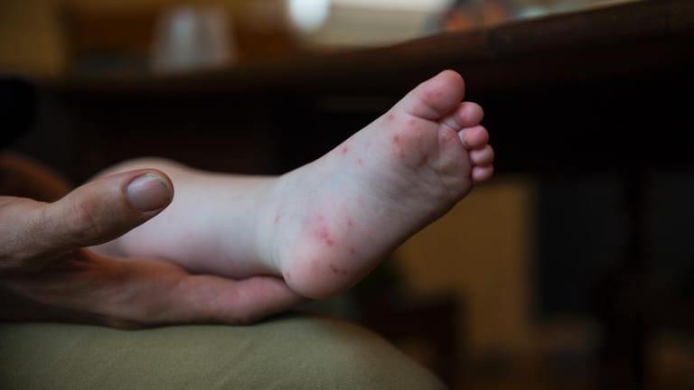 Hand-Fuß-Mund-Krankheit: Die Viruserkrankung trifft meistens Kinder unter zehn Jahren.
