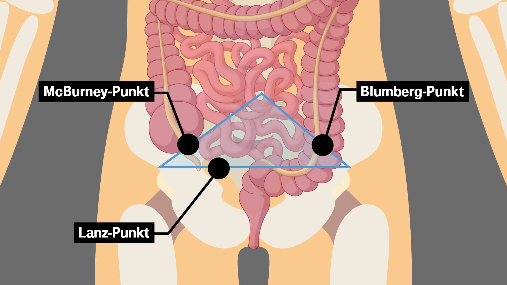 Druckpunkte zur Diagnose: Diese drei Stellen muss der Arzt kennen, um eine Blinddarmentzündung per Tastuntersuchung nachzuweisen.