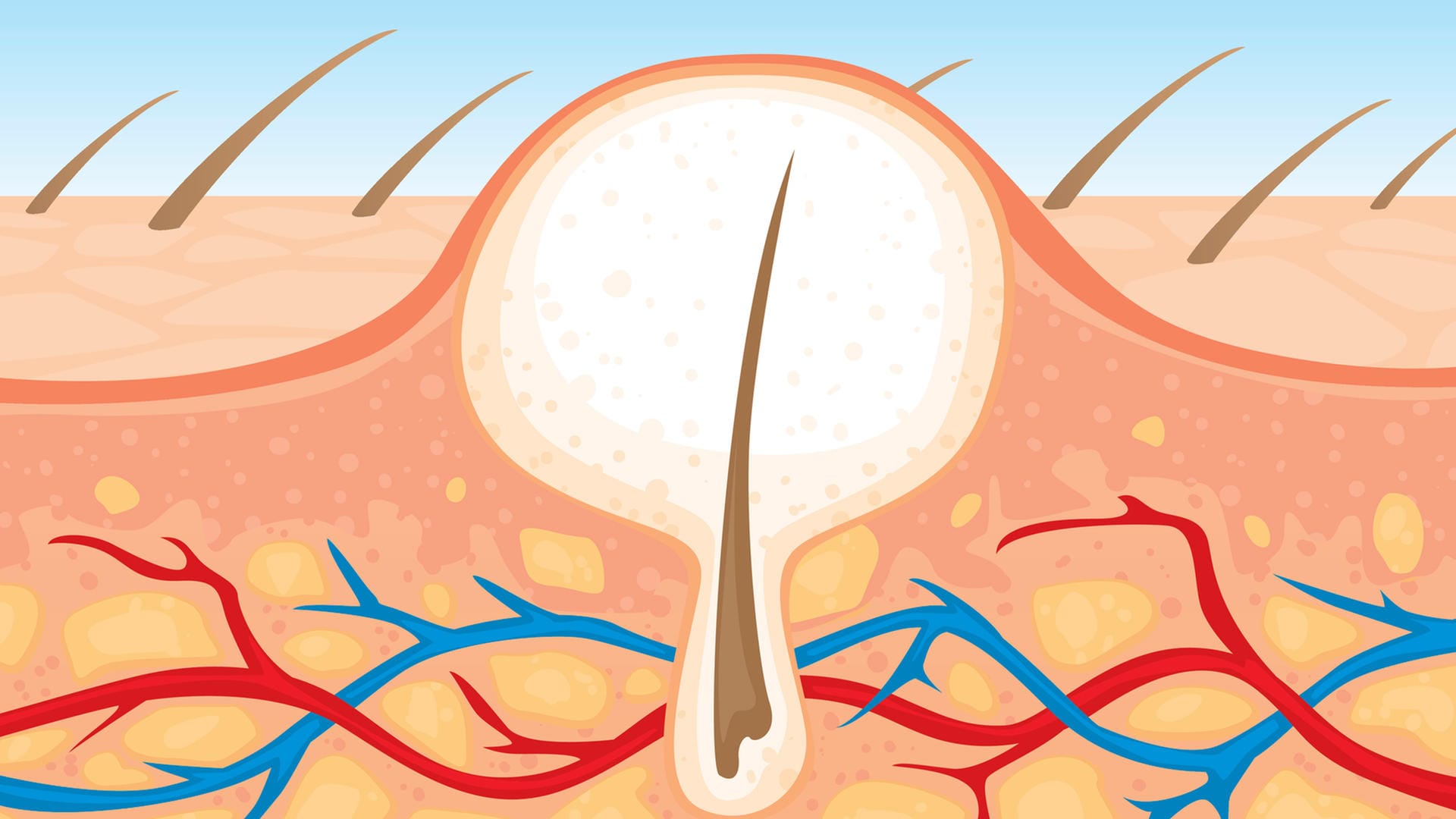 Eingewachsenes Haar: Eine eitrig entzündete Haarwurzel ist ein Furunkel.