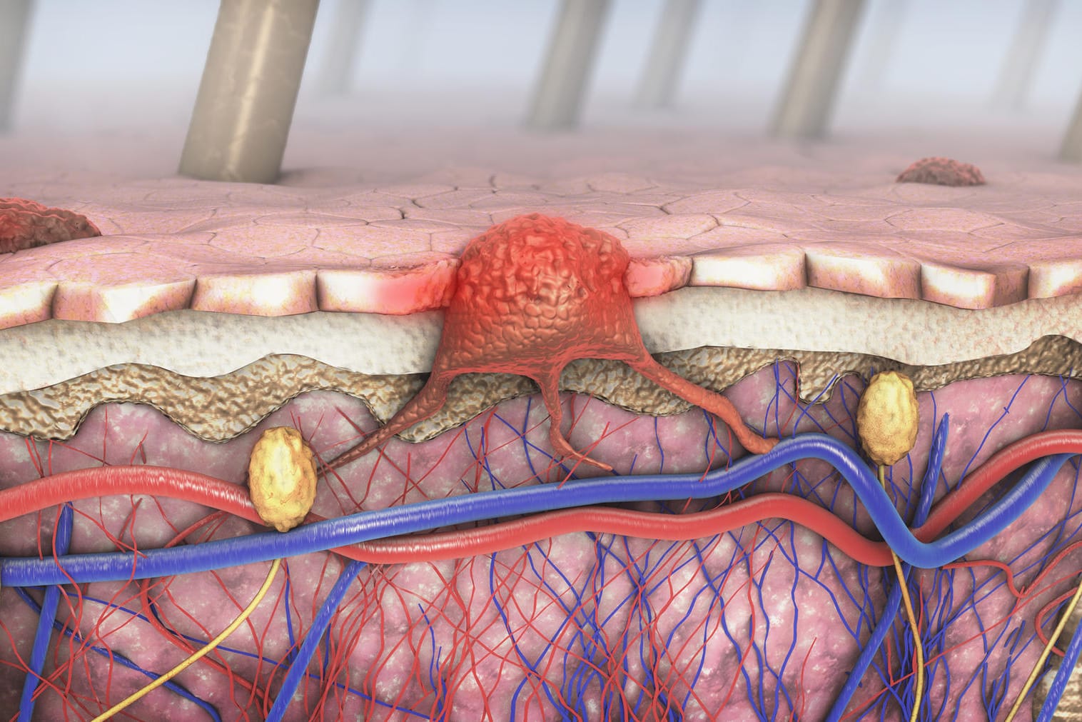 Malignes Melanom: Der Tumor verbindet sich mit den Blut- und Lymphbahnen.