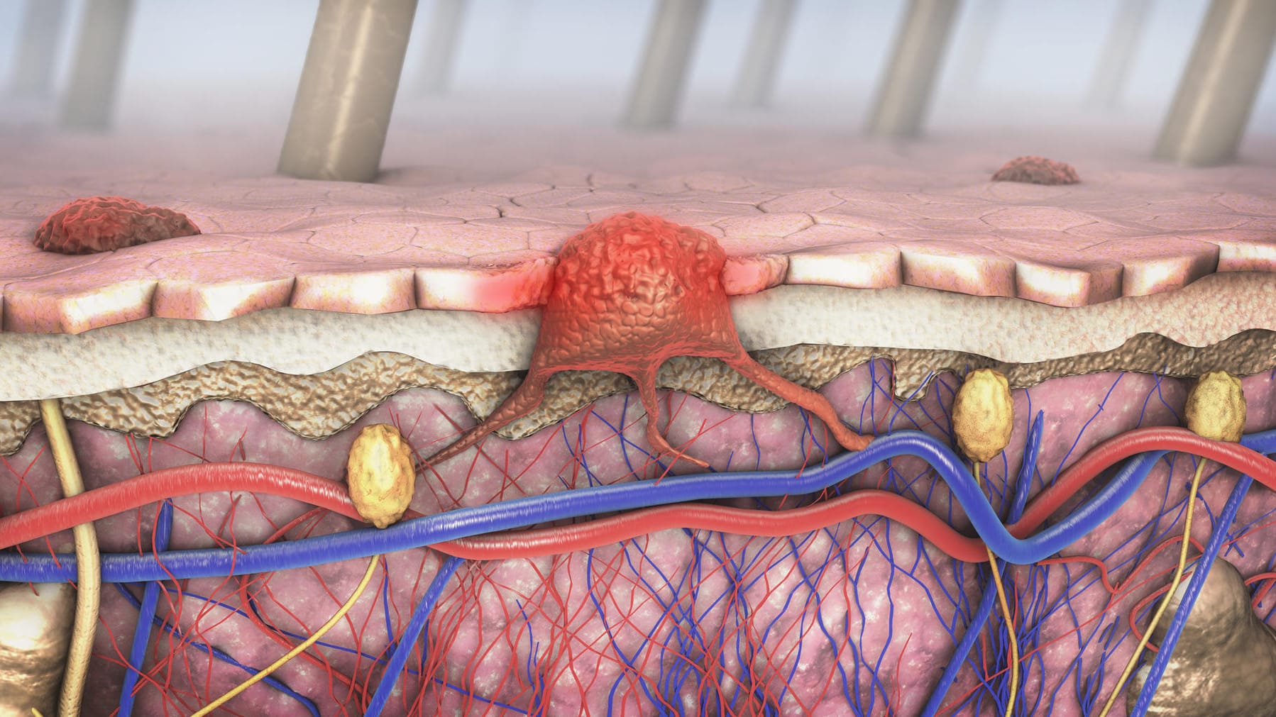 Malignes Melanom: Der Tumor verbindet sich mit den Blut- und Lymphbahnen.