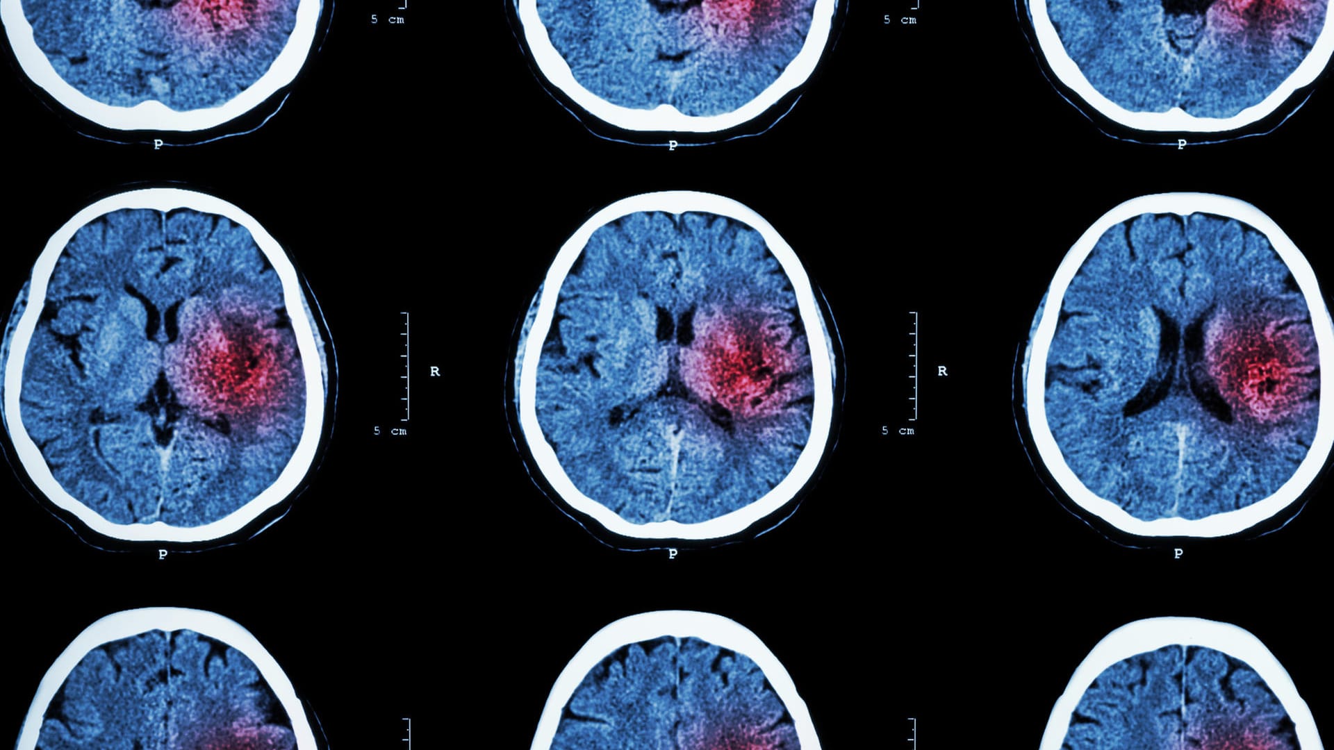 Computertomografie: Bei einem Schlaganfall oder Herzinfarkt brauchen Betroffene umgehend ärztliche Hilfe.