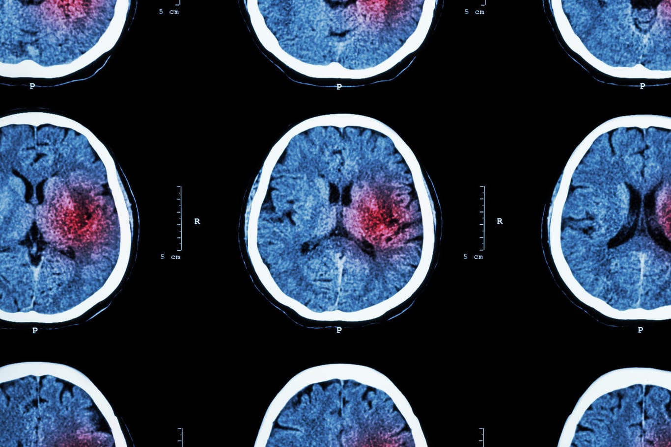 Computertomografie: Bei einem Schlaganfall oder Herzinfarkt brauchen Betroffene umgehend ärztliche Hilfe.