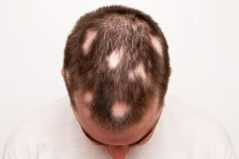 Kreisrunder Haarausfall macht Betroffenen Angst. Eine konkrete Diagnose gibt es nicht.