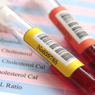 Blutwerte: Mit einem einfachen Test lässt sich feststellen, in welchem Verhältnis die Blutfettwerte zueinander stehen.