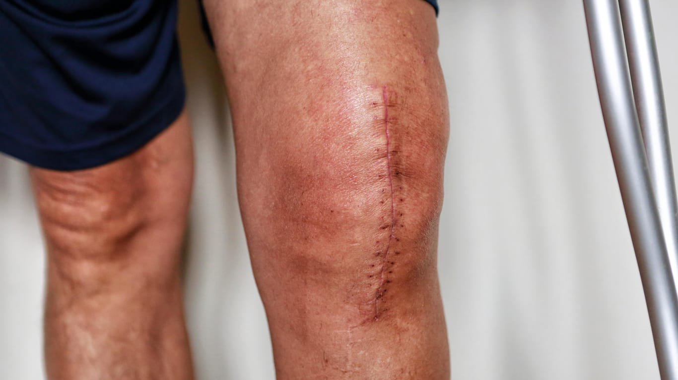 Narbe auf dem Knie: Nach einer Operation haben viele Patienten mit Narbenschmerzen zu kämpfen.