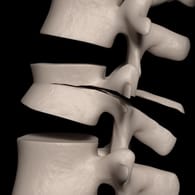 Ein durch Osteoporose bedingter Wirbelbruch kann zu chronischen Rückenschmerzen führen.