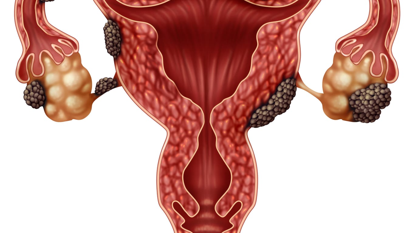 Querschnitt durch die Gebärmutter: Die schwarz markierten Ablagerungen zeigen Endometrioseherde.