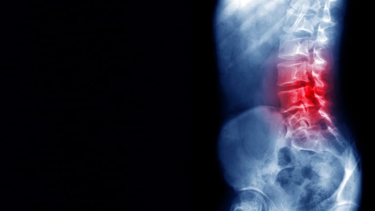 Röntgenaufnahme des unteren Rückens: Im Zuge einer Osteoporose kommt es häufig zu Wirbelkörperbrüchen. Die Folge sind Schmerzen und ein Einsacken der Wirbelsäule.